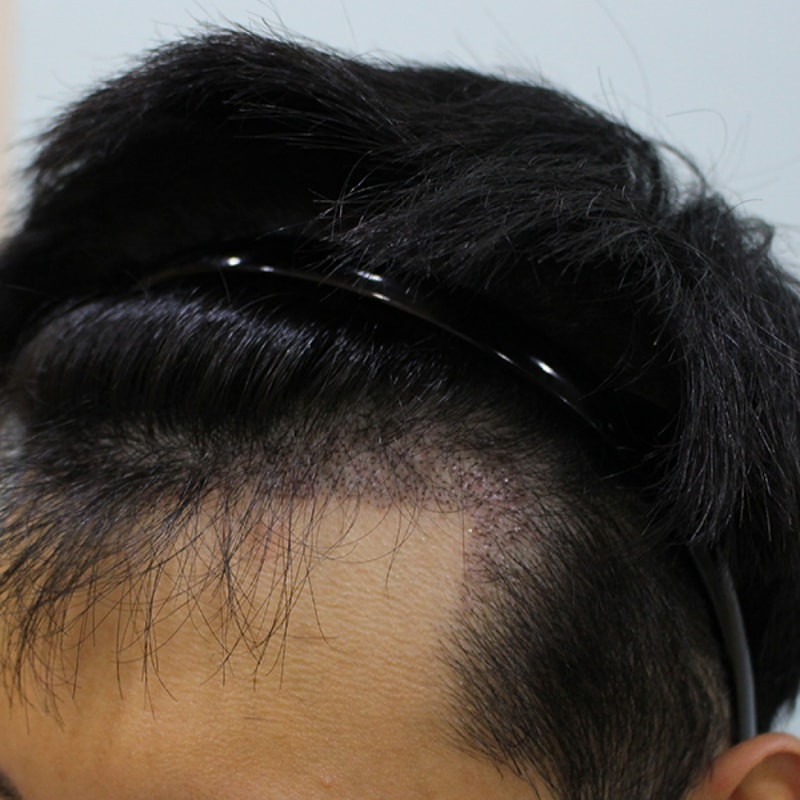 수술후 10일 (1).JPG