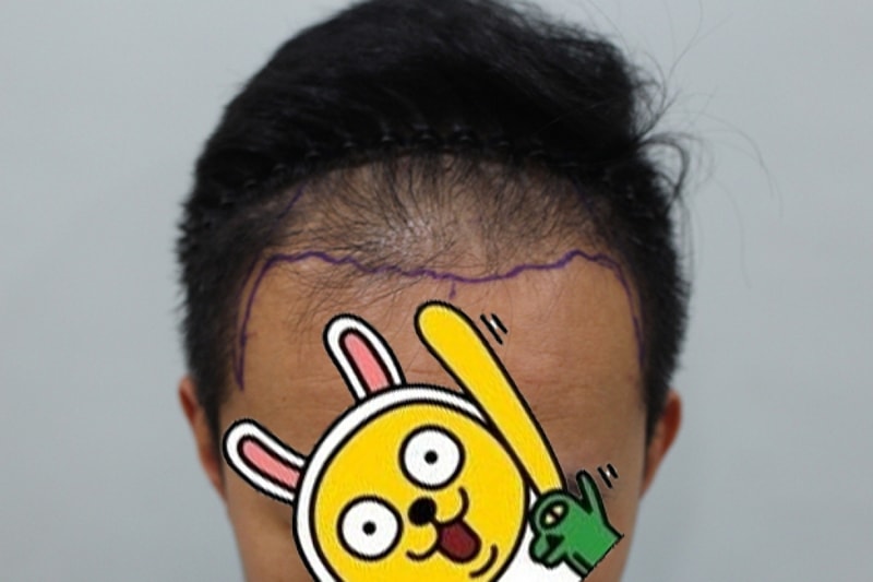 수술전디자인 (2).JPG