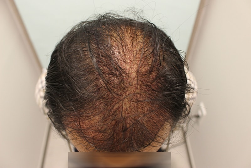 수술후 1일 (10).JPG