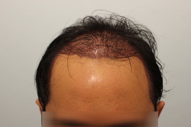 수술후 1일 (2).JPG