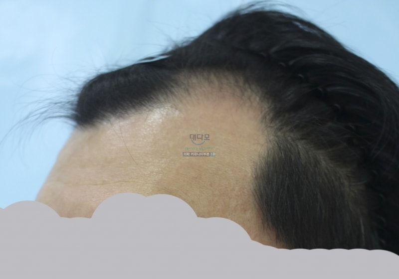 이식전 (4).png