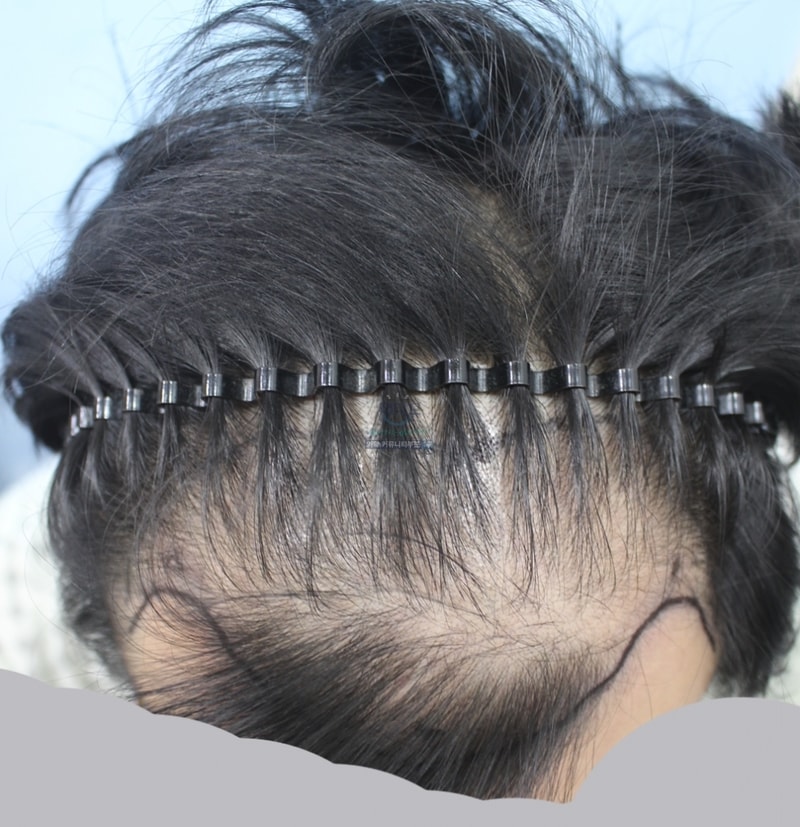 이식전 (2).png