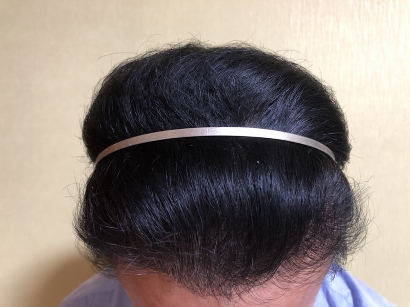 다나 롱헤어무삭발 5개월