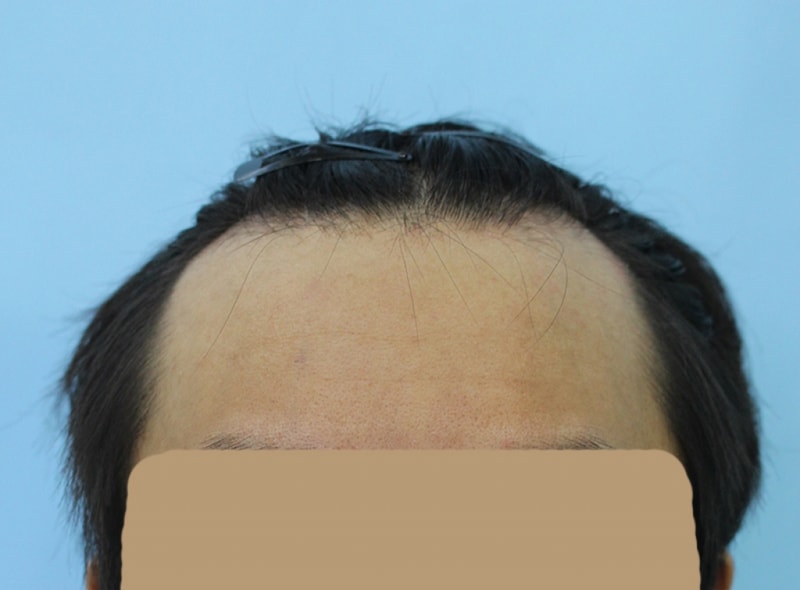 절개3500모… M자탈모 모발이식했어요