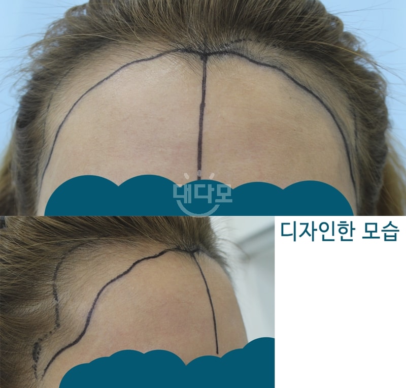 헤어라인 이식 4개월 되었어요 *^^*