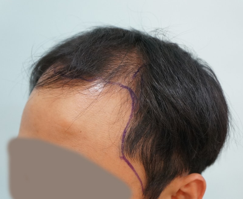 수술전 디자인 (3).jpg