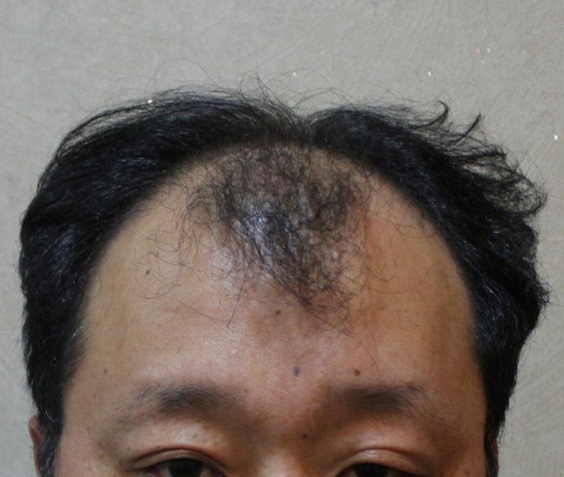 JP 절개 4700모 9개월 경과보고!