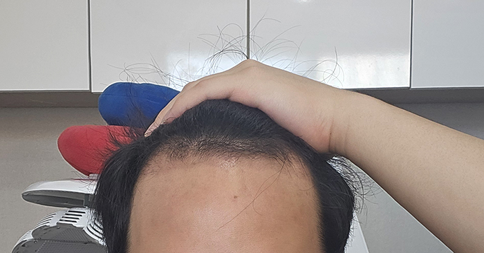 1. 수술 1개월차 주사맞기 전 셀카.jpg