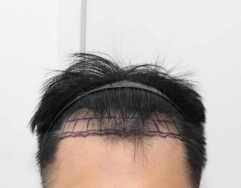 뉴헤어 비절개 m자 9개월 1800모낭 후기