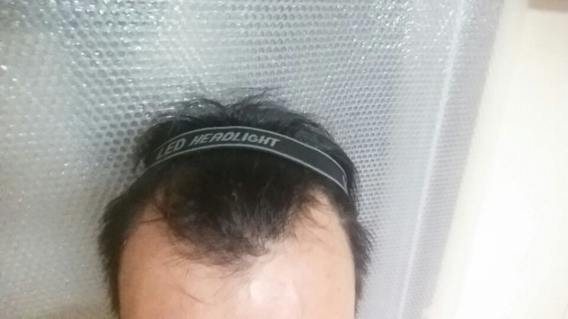 비절개 수술로 1750모낭 다나성형외과에서 받은 후기요