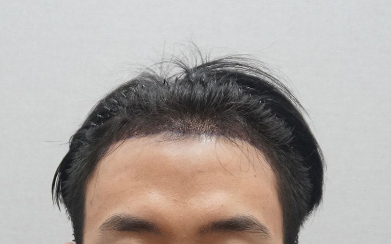 07-4 수술다음날.JPG