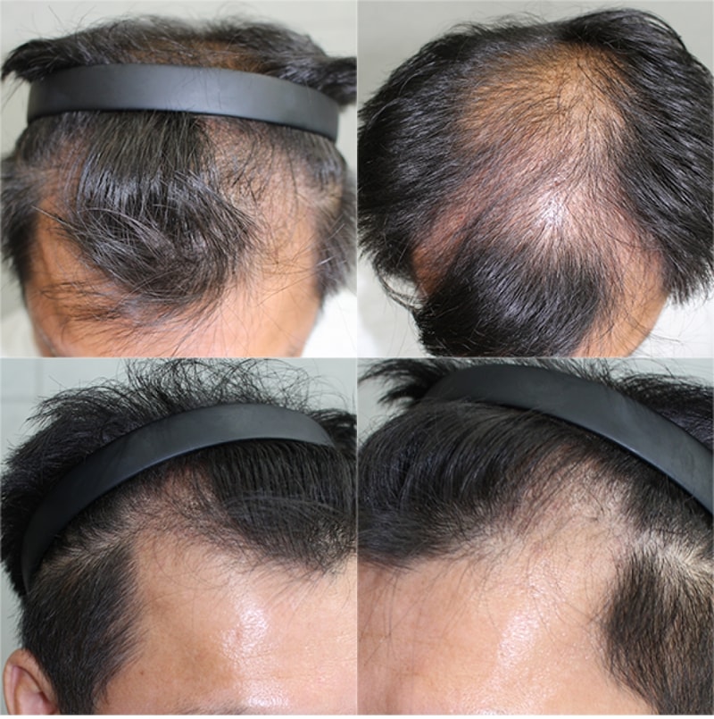 薄毛克服中.. もう半分（約6ヶ月）ぐらい来ましたね