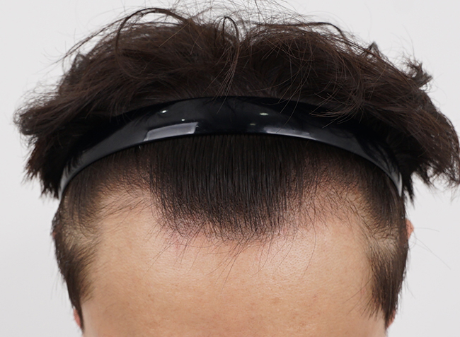 모모성형외과 비절개 2400모 수술 한달