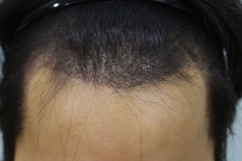 수술후11일 (2).JPG