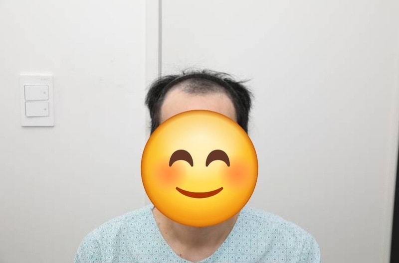뉴헤어 서울점 절개 모발이식 2000모낭 3개월차 후기