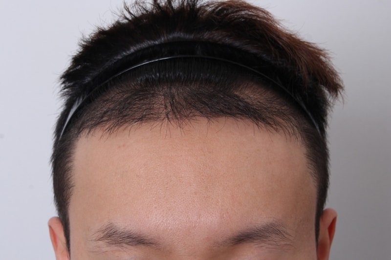 크기변환_2차 수술 전 정면.JPG