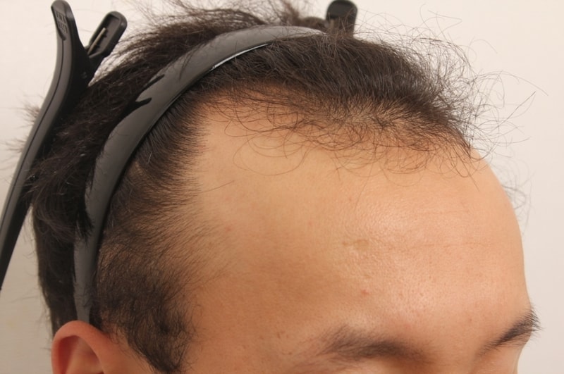 크기변환_수술전 우.JPG
