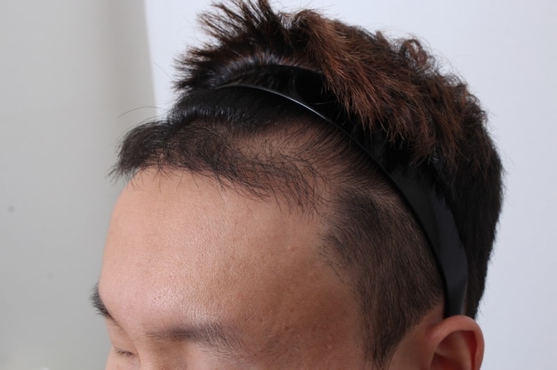 크기변환_2차 수술 전 좌.JPG