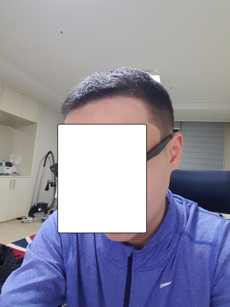 수술 후 1개월 좌.jpg