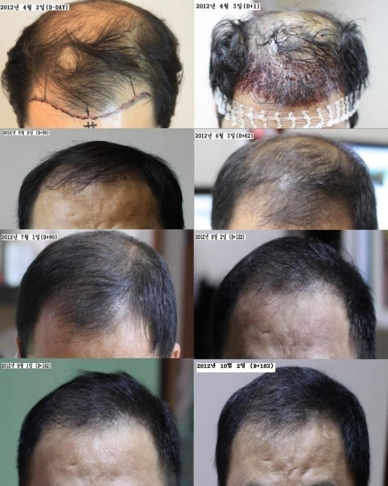 수술전-수술후6개월(20121002).JPG