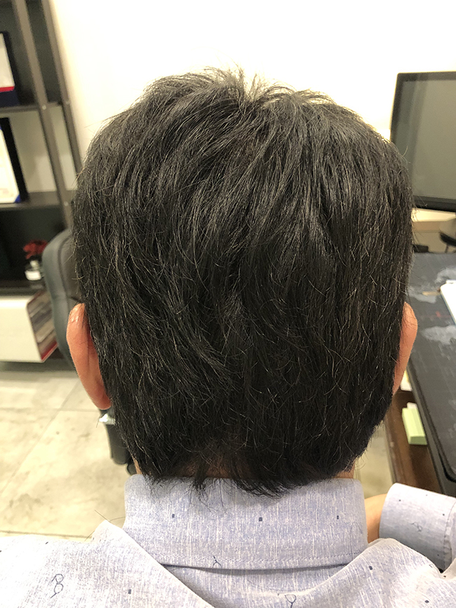 수술후 10일.jpg