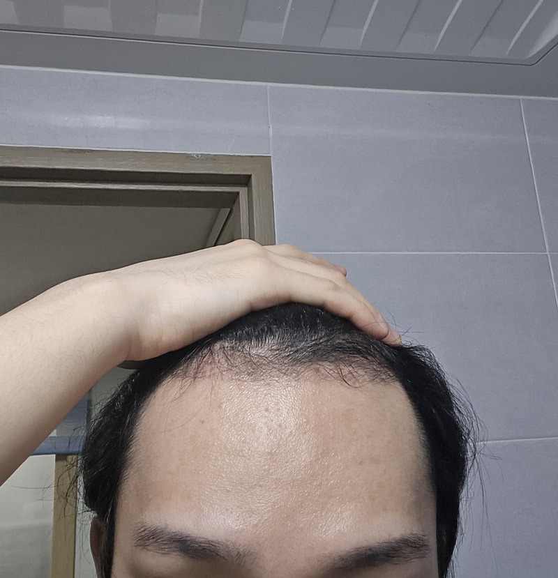 뉴헤어모발성형외과 1700모낭 3개월차 후기