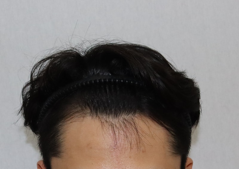 모디헤어플란트에서 3000모 모발이식 했어요