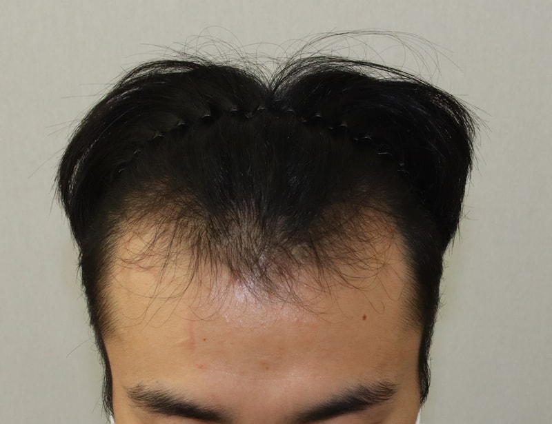 4000모 모발이식 한지 3개월이 지났네요!