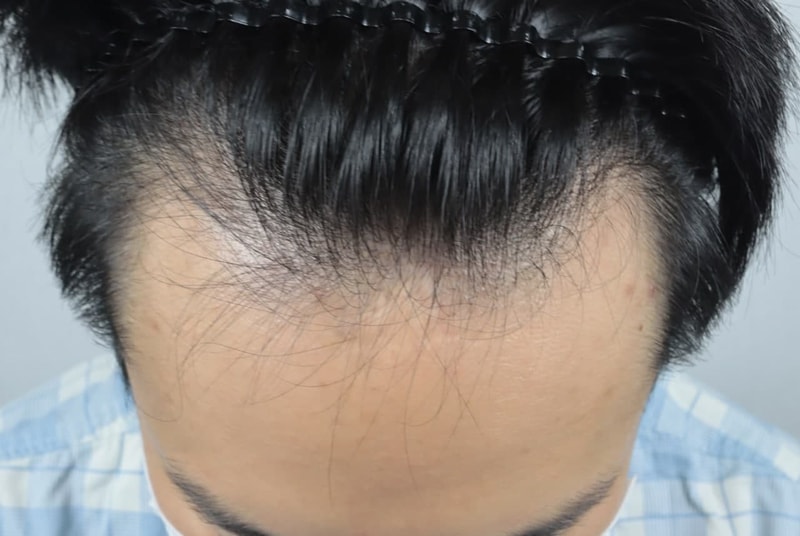 엠자 탈모 비절개 비삭발 모발이식 후기입니다(2500모)