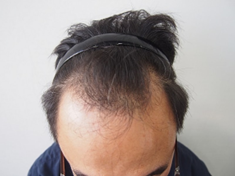 수술전 정면2 - 복사본.JPG