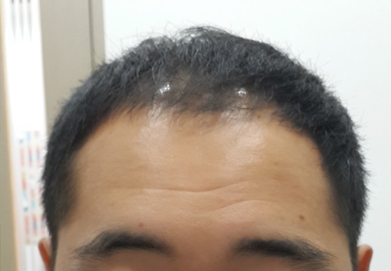 수술전 정면.jpg