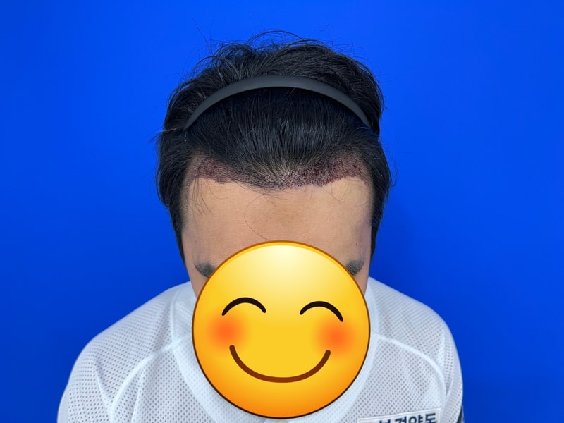 모발이식수술후 다음날.jpg