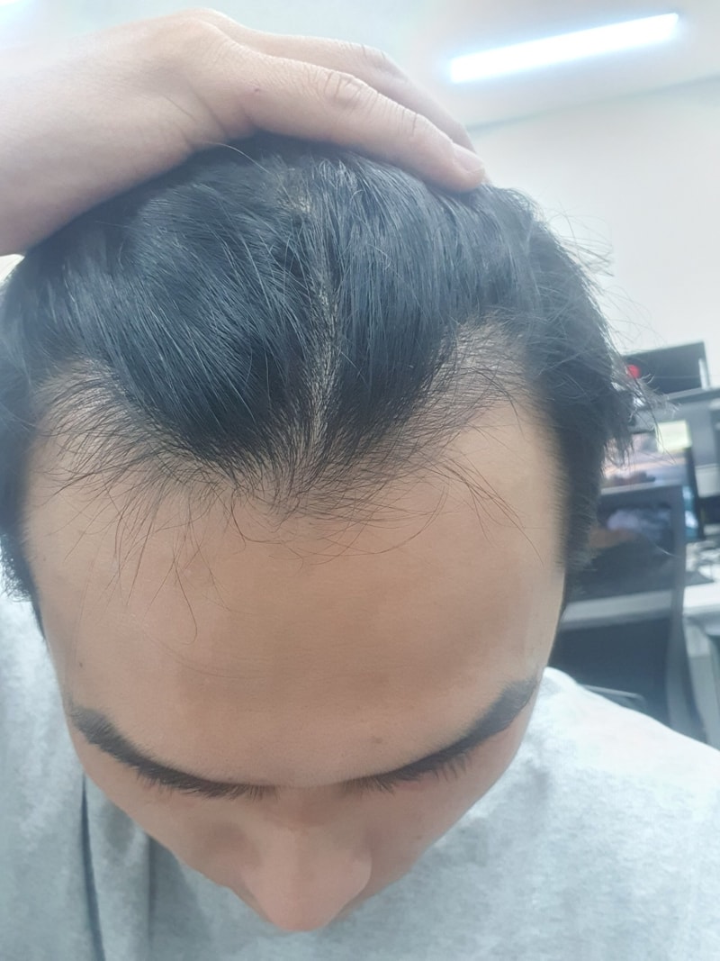 모발이식수술전.jpg
