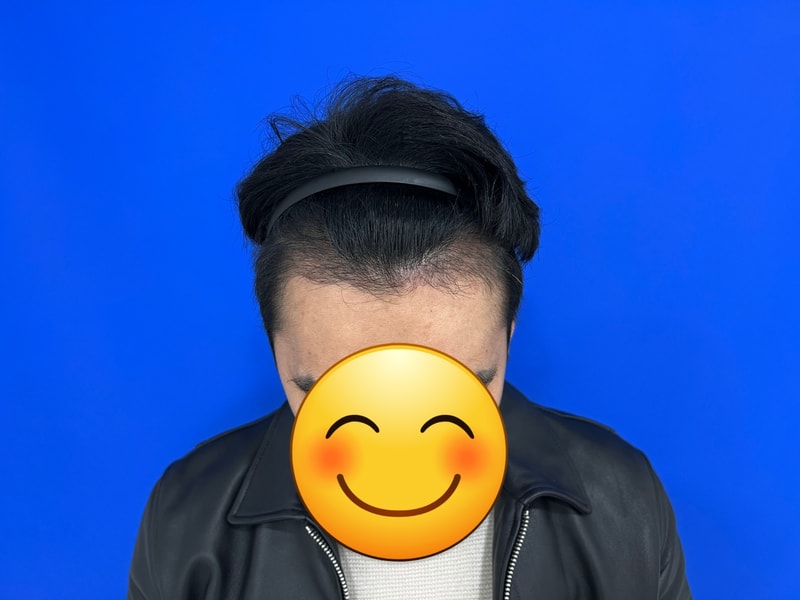 모발이식3개월차.jpg