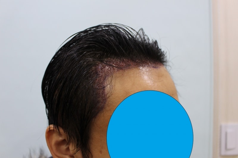 수술직후 (1)- 모자이크1.jpg