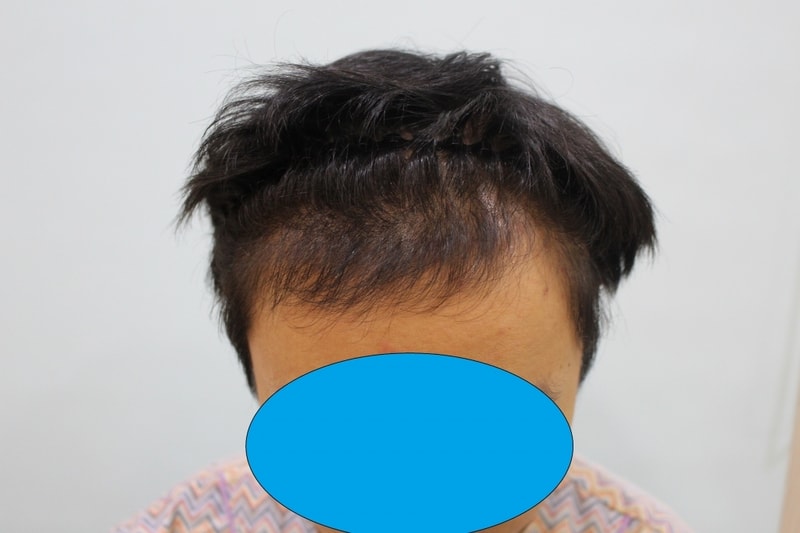수술전 (2)- 모자이크1.jpg