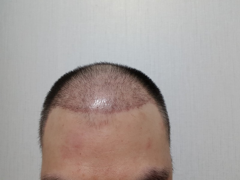 06. 수술17일.jpg