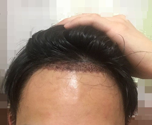 어제 수술받고 왔습니다. 촘촘해보이나요?