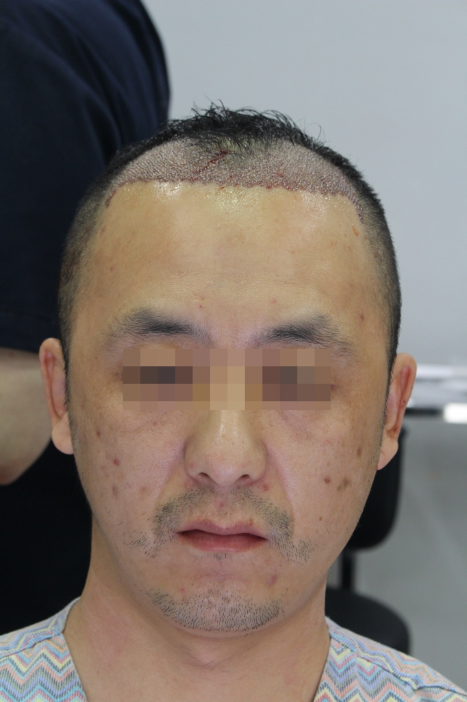 모앤블레스에서 수술 받았어요. 잘 된 것 같나요?