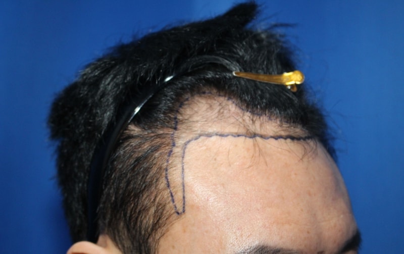 I also had surgery 2860 Moyo