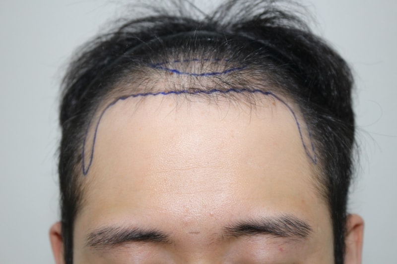 3370모 이식했어요...뒷머리 약간 따끔거리네요