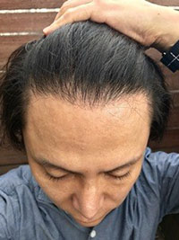 6. 수술6개월차.jpg
