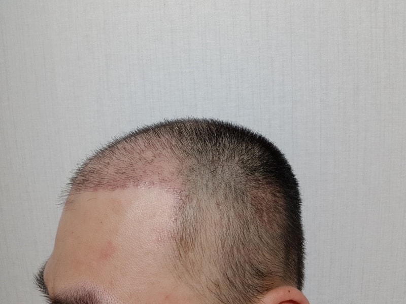 08. 수술17일.jpg