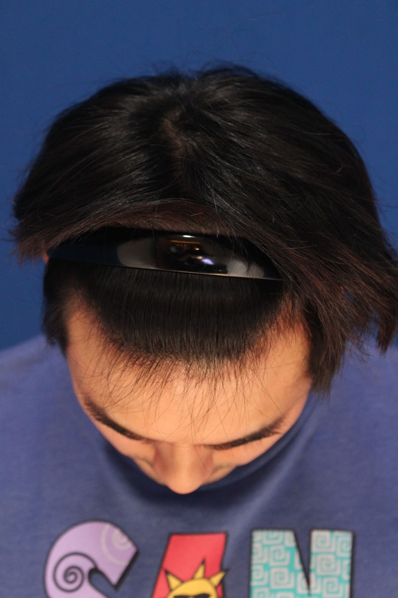 수술3개월째-3.jpg