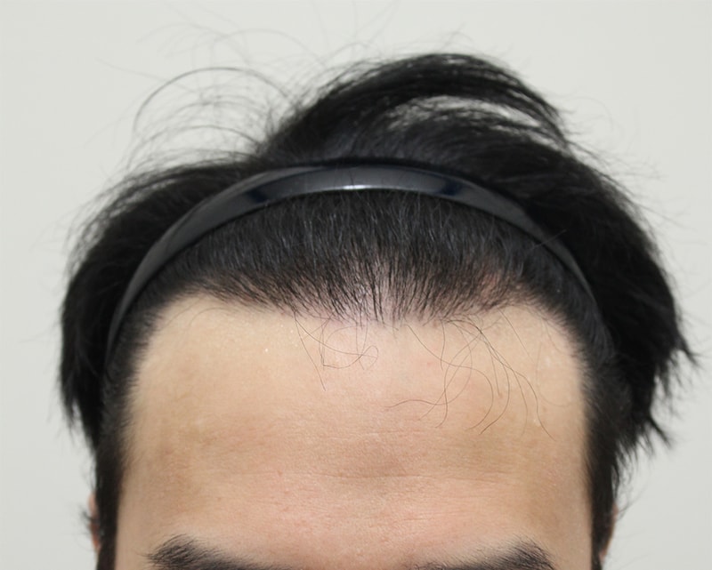 8.수술9개월후.jpg