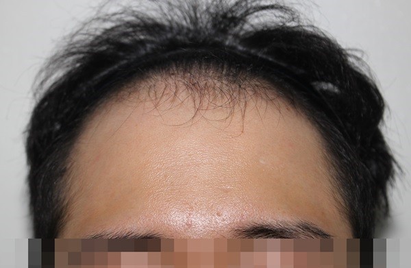 수술 9개월 지났습니다
