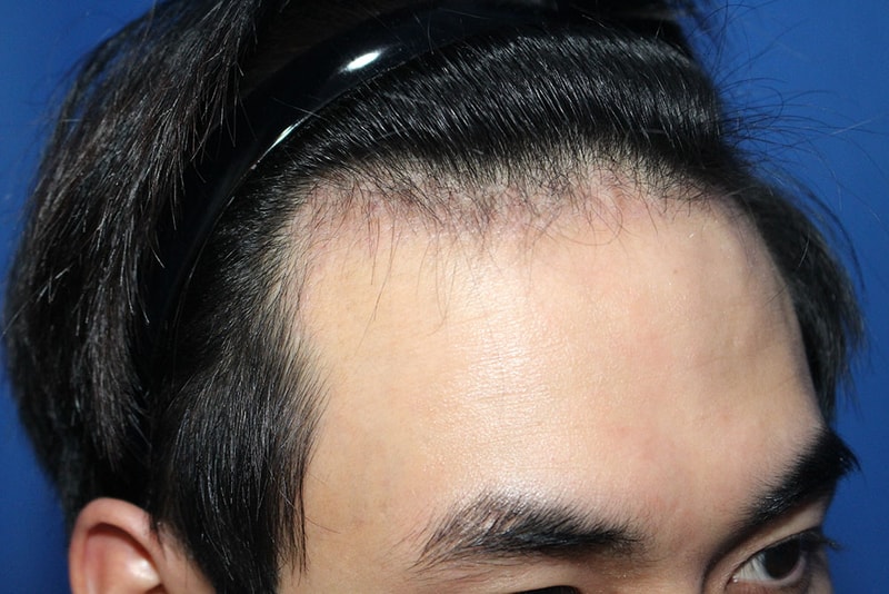 수술3개월째-1.jpg