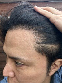7. 수술6개월차.jpg