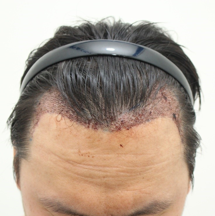 수술1일째.jpg