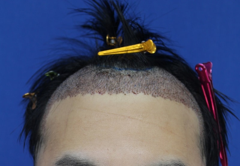 2. 수술1일째.jpg